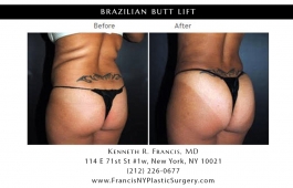 brazilian-butt-lift-nyc-before-after-case-1000-1