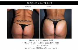 brazilian-butt-lift-nyc-before-after-case-1000-3