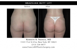 brazilian-butt-lift-nyc-before-after-case-1024-2