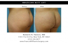 brazilian-butt-lift-nyc-before-after-case-1025-3