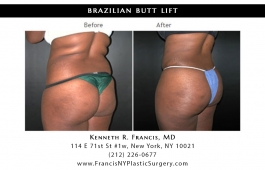 brazilian-butt-lift-nyc-before-after-case-1027-1