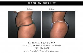 brazilian-butt-lift-nyc-before-after-case-1027-2