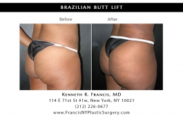brazilian-butt-lift-nyc-before-after-case-1028-2