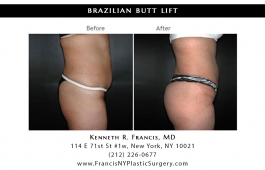 brazilian-butt-lift-nyc-before-after-case-1028-5