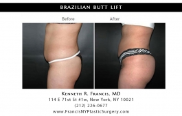 brazilian-butt-lift-nyc-before-after-case-1028-6