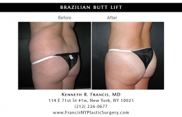 brazilian-butt-lift-nyc-before-after-case-1029-1