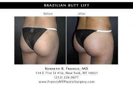 brazilian-butt-lift-nyc-before-after-case-1030-2