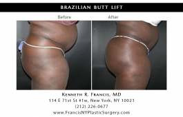 brazilian-butt-lift-nyc-before-after-case-1032-1