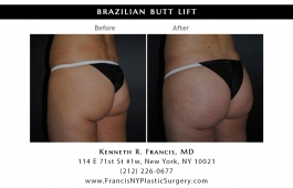 brazilian-butt-lift-nyc-before-after-case-1033-2