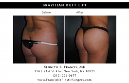 brazilian-butt-lift-nyc-before-after-case-1034-3