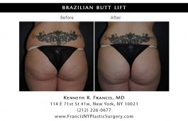 brazilian-butt-lift-nyc-before-after-case-1036-1