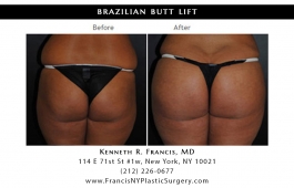 brazilian-butt-lift-nyc-before-after-case-1037-1