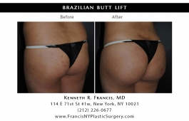brazilian-butt-lift-nyc-before-after-case-1038-3
