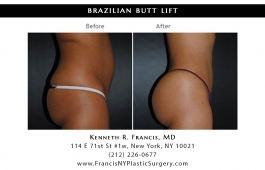 brazilian-butt-lift-nyc-before-after-case-1040-3