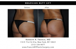 brazilian-butt-lift-nyc-before-after-case-1041-1