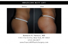 brazilian-butt-lift-nyc-before-after-case-1041-2