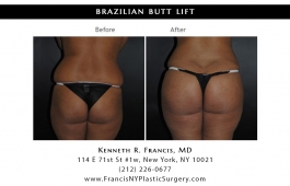 brazilian-butt-lift-nyc-before-after-case-1043-3
